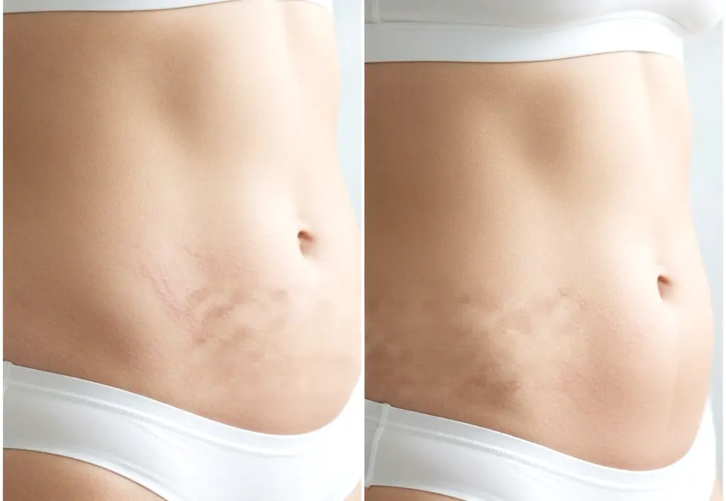 Results of using Palmers Stretch Marks Cream – improved skin elasticity and smoothness